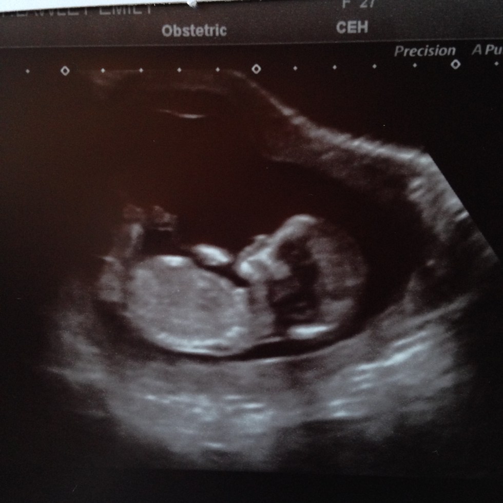 My 12 week scan