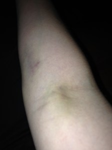 My poor, post-blood-test bruised arm